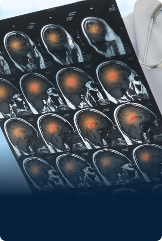 Photo of brain injury