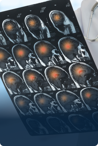 Photo of brain injury
